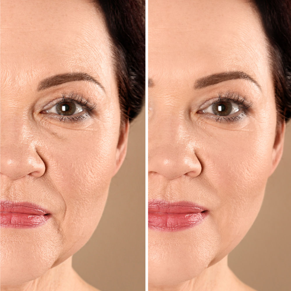 Vorher-Nachher-Hyaluron